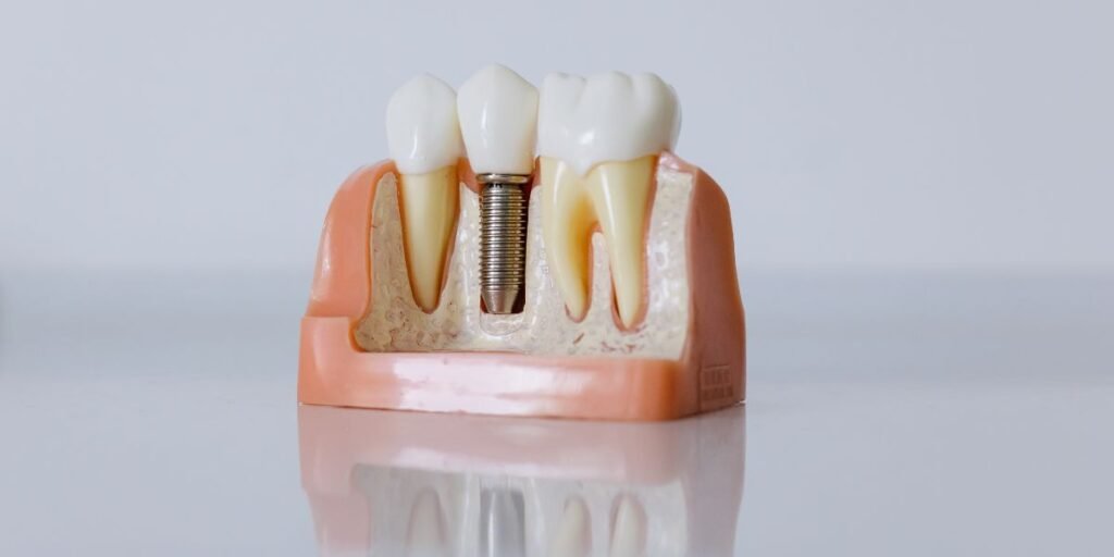 dental implants