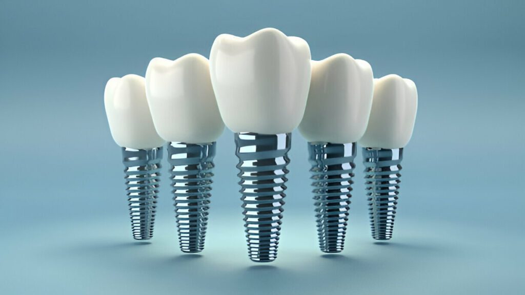 Dental implants