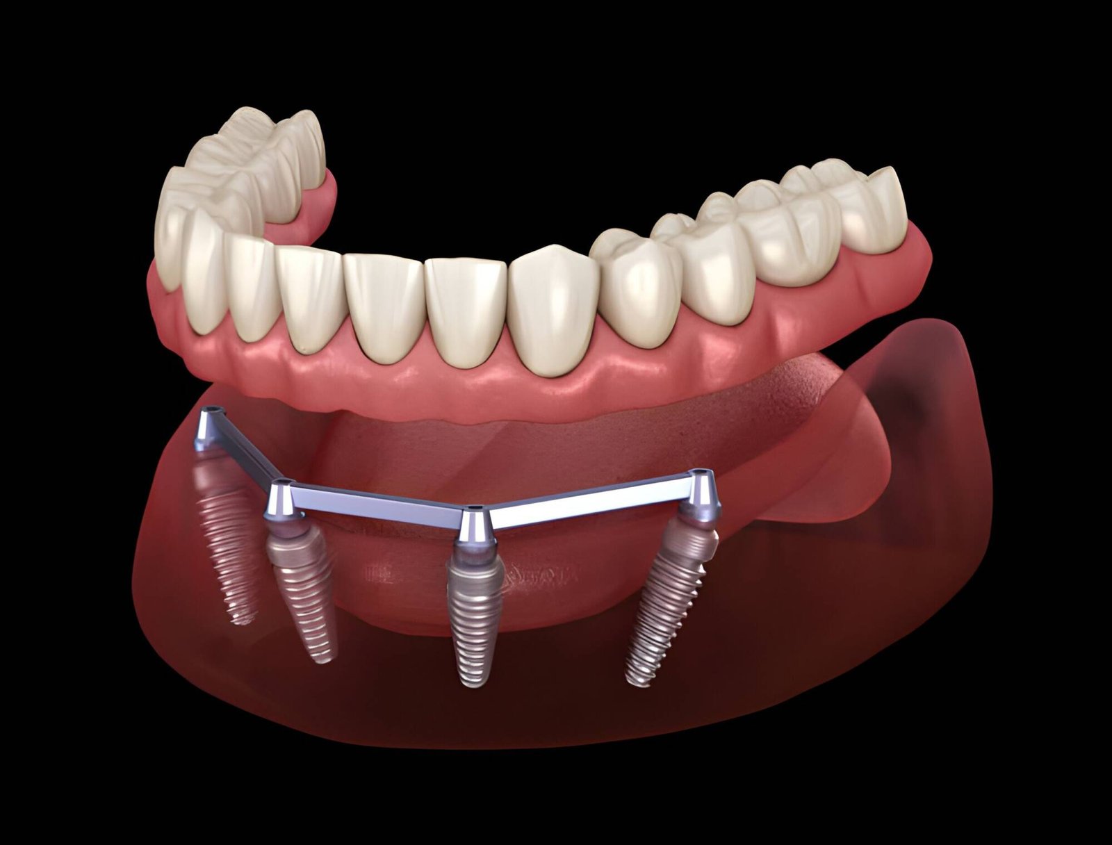 How much is all-on-4 dental implants UK?
