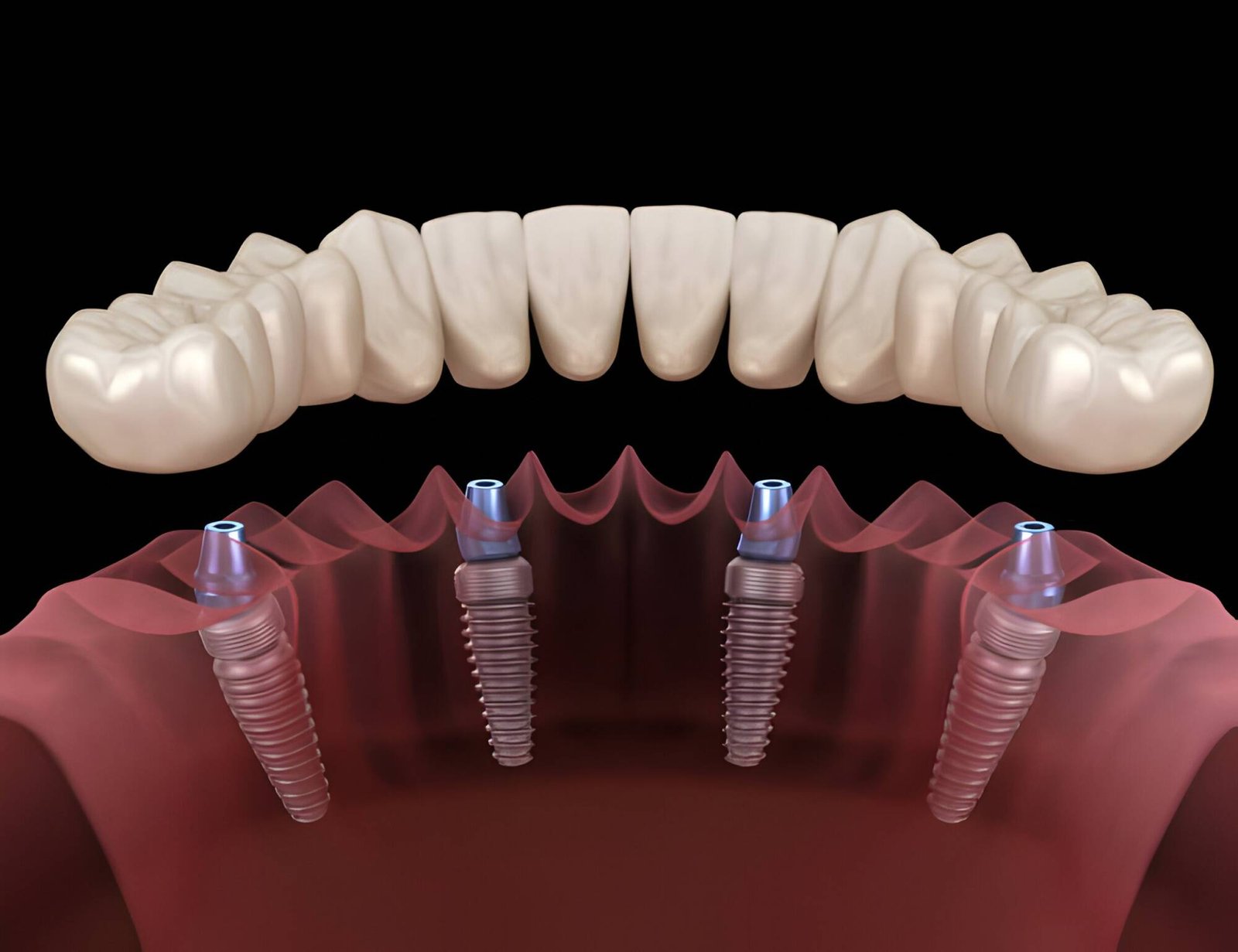 Can One Implant Replace Two Teeth