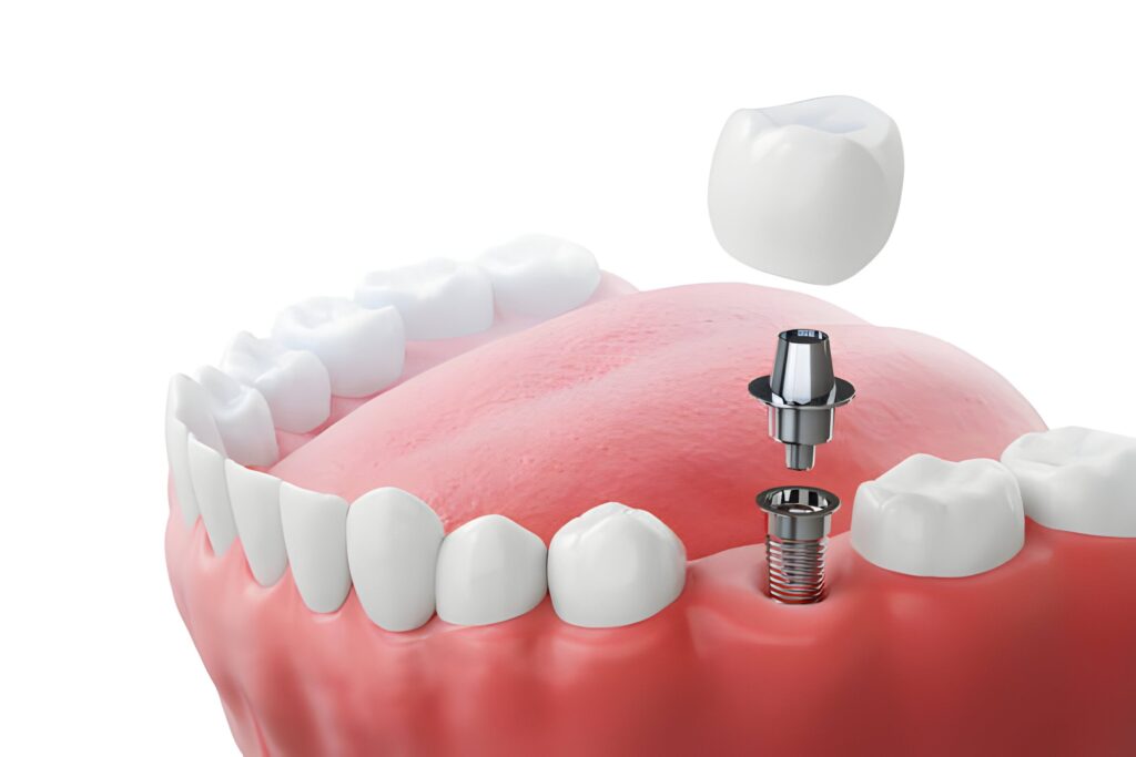 Dental Implants